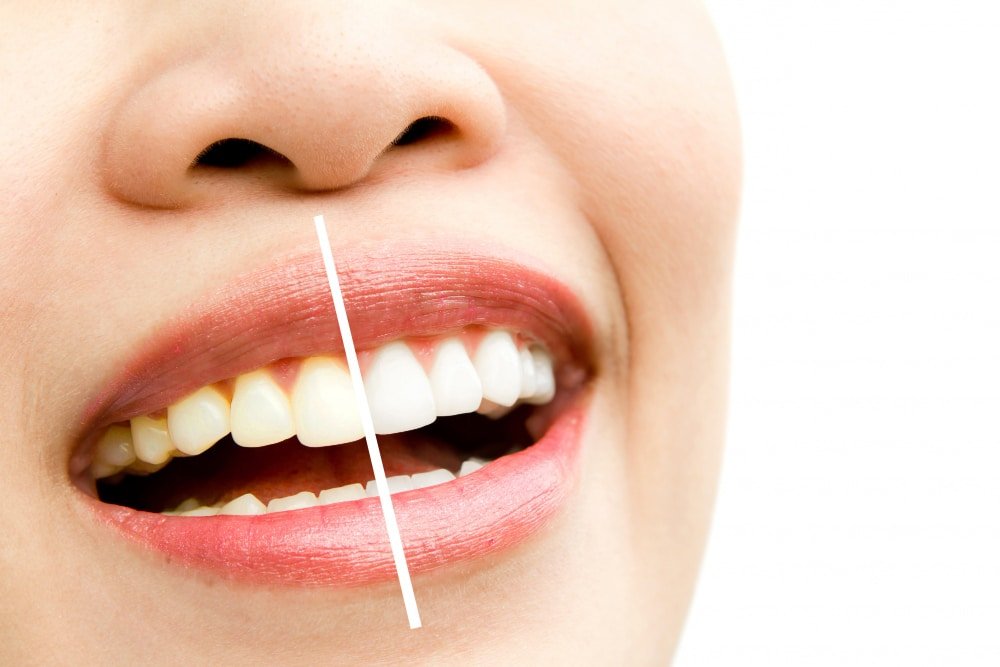 Teeth Whitening | Achieve a Brighter Smile | All Smilez